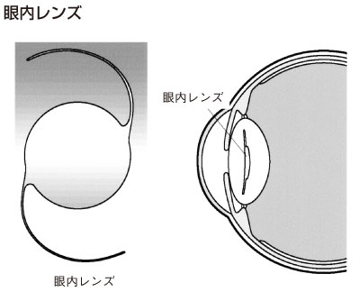 眼内レンズ