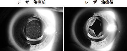 レーザー治療前とレーザー治療後の写真