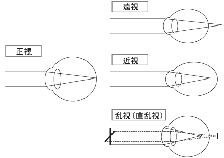 水晶体を眼内レンズに置き換える