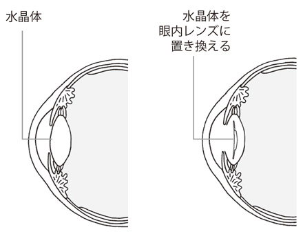 水晶体を眼内レンズに置き換え説明図