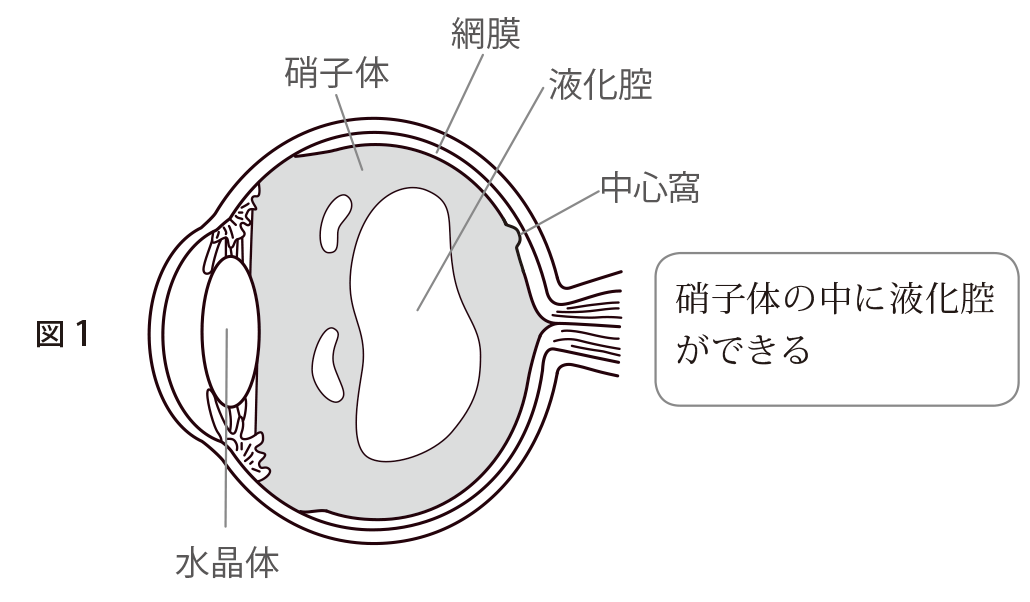 図1 硝子体の中に液化腔ができる